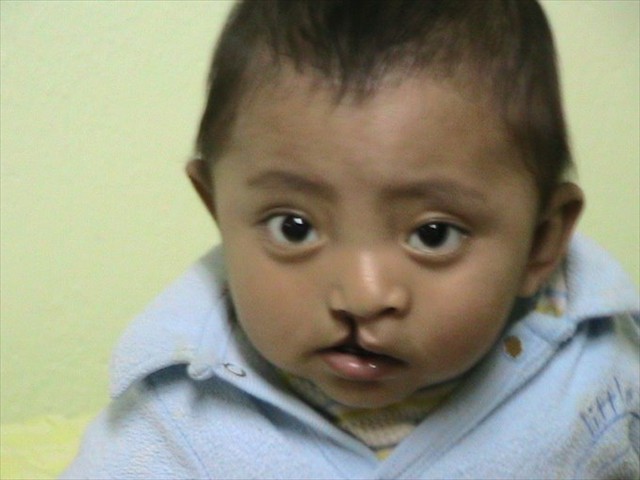 Guatemalan patient willing and able to thrive after our Mission of LOVE medical team intervention.
